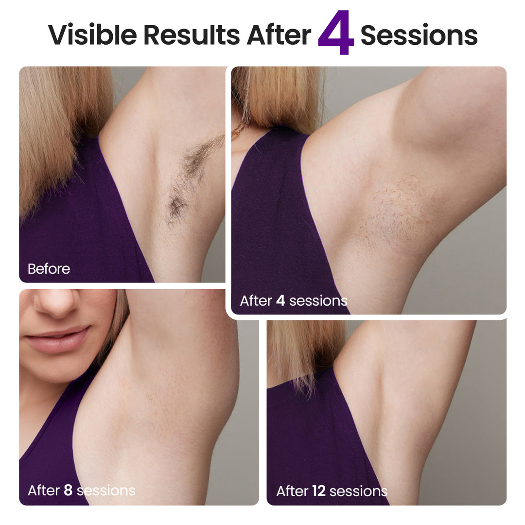 NAISIGOO IPL Laser Hair Removal Device For Women and Men